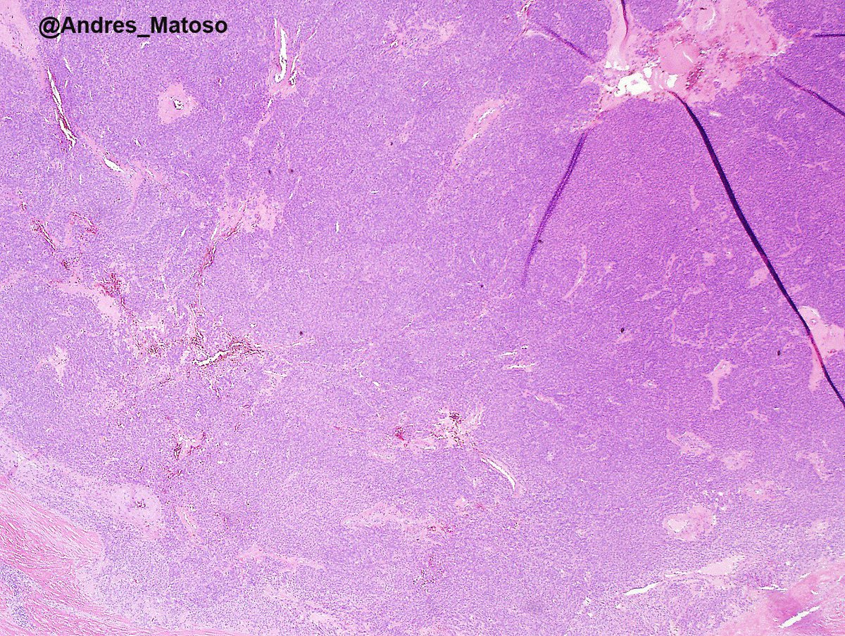 Andres_Matoso's tweet image. Paratesticular tumor. Unusual location but classic morphology for a glomus tumor! 😀😀 #gupath #pathology