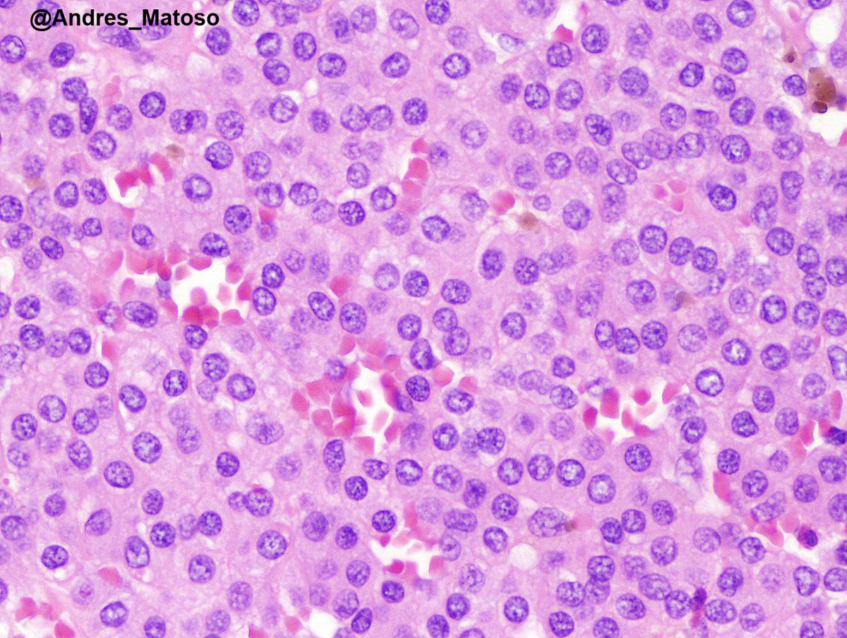 Andres_Matoso's tweet image. Paratesticular tumor. Unusual location but classic morphology for a glomus tumor! 😀😀 #gupath #pathology