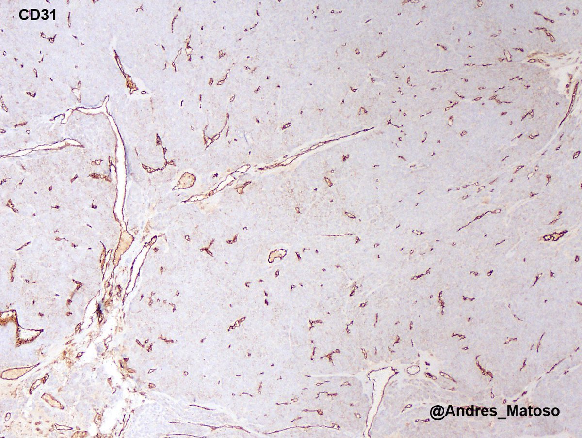 Andres_Matoso's tweet image. Paratesticular tumor. Unusual location but classic morphology for a glomus tumor! 😀😀 #gupath #pathology