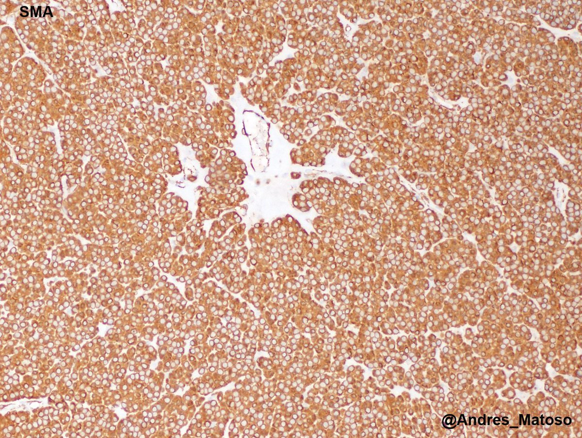 Andres_Matoso's tweet image. Paratesticular tumor. Unusual location but classic morphology for a glomus tumor! 😀😀 #gupath #pathology