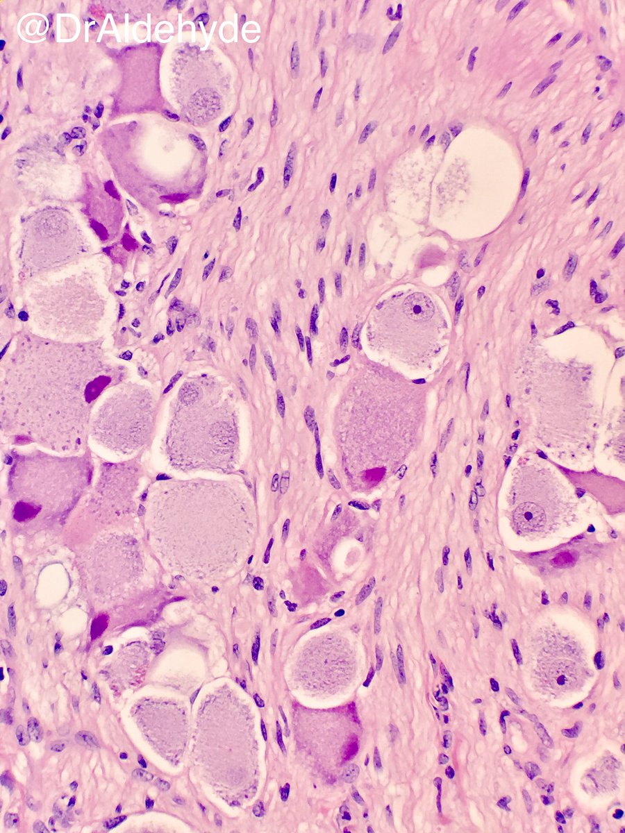 Ganglioneuroma = ganglion cells 🥑 + schwannian stroma/cells ⚡️#pedipath #adrenalgland #pathology #schwanncell #ganglioncell #hhpath