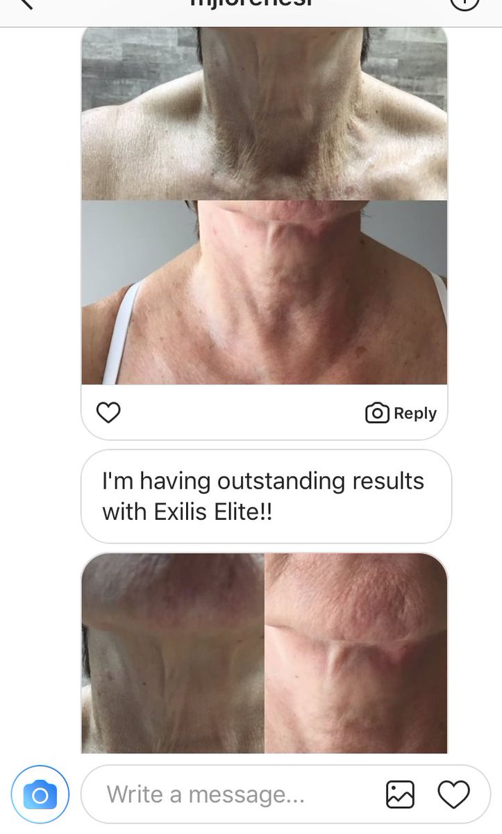 BTLAestheticsUK's tweet photo. For instance, we received this off a clinic who are super happy with results achieved using BTL Exilis Elite #btlexiliselite #btlexilisultra https://t.co/kBLA8Ap1fc