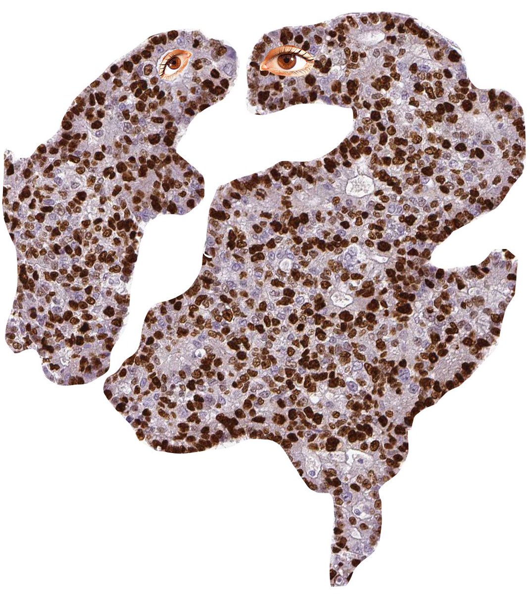 Malicious creatures that proliferate (Ki-67 #immunohistochemistry) from a lung cancer. Origin spotted in the @HumanProteome!