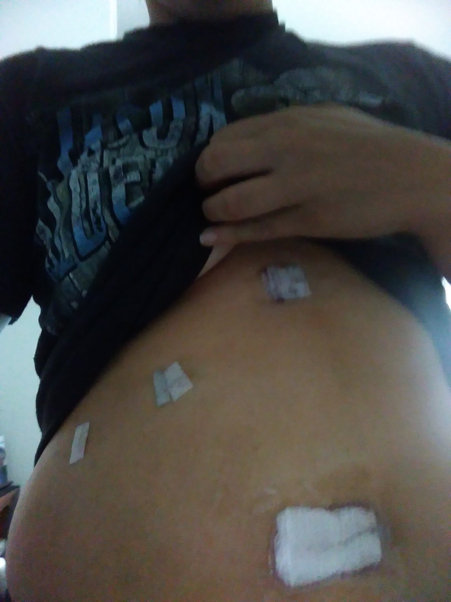 michaelawhite__'s tweet photo. @Hopesaprincess_ I'm swollen like a fucking balloon https://t.co/PIFG5YNJme