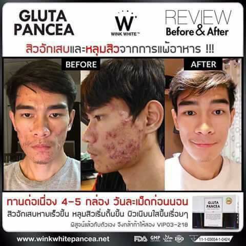kwang_siri27's tweet photo. 😘รู้มั้ยค่ะว่า.."กลูต้าแพนเซีย" มีส่วนผสมจาก Zinc (ซิงค์) ด้วยน๊าา💖..ซึ่งช่วยลดการเกิดสิวทุกชนิด✨
#GLUTAPANCER
🆔LINE: kawintra99ww https://t.co/j2sJFXl4qe