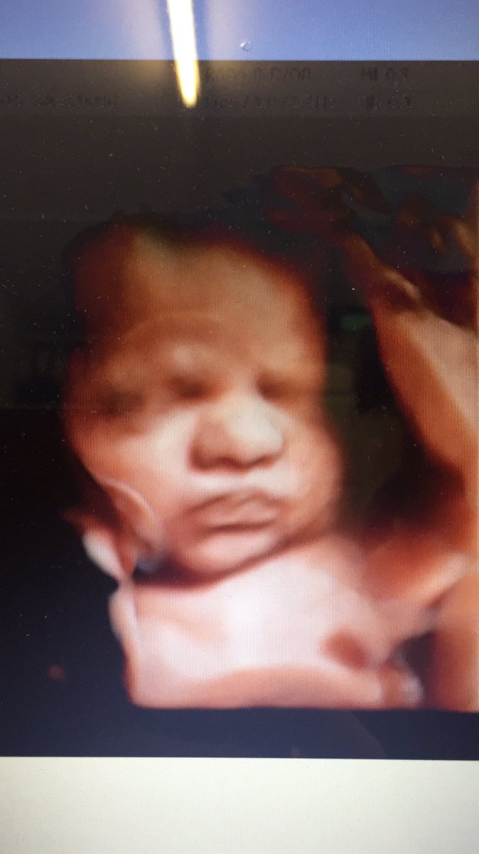 nikknok's tweet photo. How lucky I am spending my working days making families happy @TakeAPeek3D #HDscan #beautifulbaby #ilovemyjob ❤️ https://t.co/7HrNvw1CAq