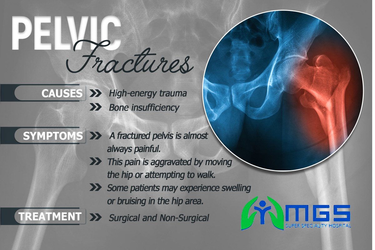 MGSCMO1's tweet photo. Know more about #PelvicFractures
#MgsHospital #Orthopaedic https://t.co/Metmuq8GsB
