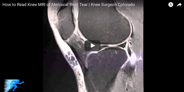 thekneedoc's tweet photo. How to Read an #MRI of a Meniscal Root Tear https://t.co/l8GsLBRhBQ https://t.co/Nea4Om8lYO