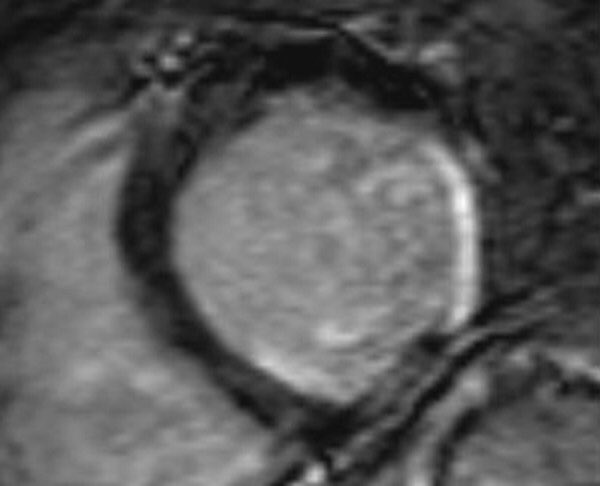 BrHeartValveSoc's tweet photo. Fibrotic or infarct scar is a strong independent predictor of mortality in pts undergoing #TAVR #SAVR @escardio https://t.co/3voey5iu8b https://t.co/hOf607sF8Q