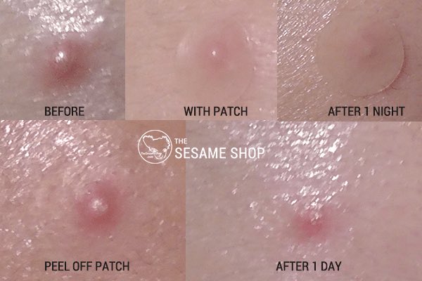 แผ่นแปะสิวcosrx🔥230฿ ฟรีems [1แผ่น24ชิ้น]😍😍
-มีhydrocolloidทำให้หัวสิวแห้งลดการอักเสบของสิว
-ป้องกันฝุ่น/เชื้อโรค
-สามารถใช้ได้แม้แต่งหน้า