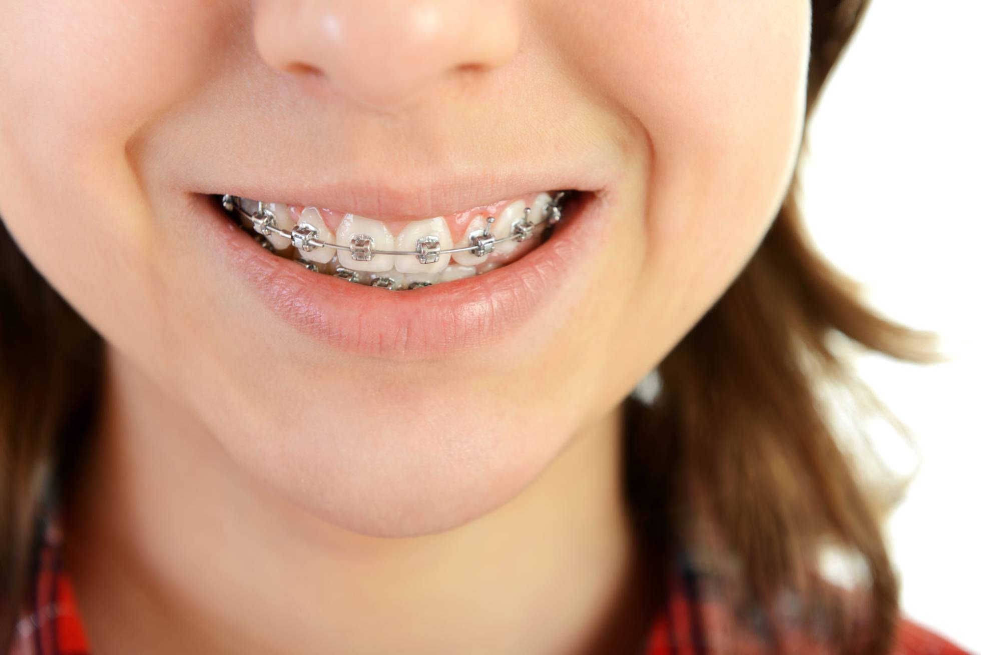Металлические брекеты на зубах у подростков