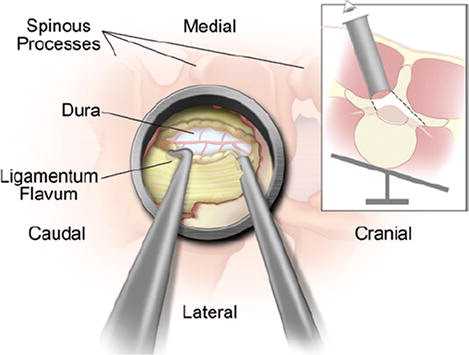 TheJNS's tweet photo. #FreeArticle: Minimally invasive laminectomy for lumbar spinal stenosis https://t.co/doNZBmVTNl https://t.co/f5TI9ukkPE