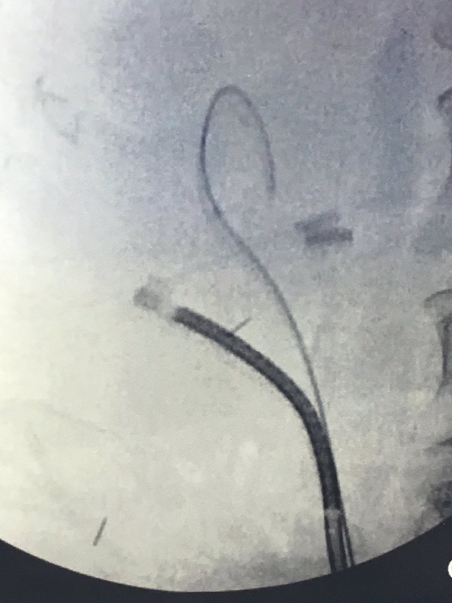 BEkidneystone's tweet photo. fURS 9mm renal stone #lithovue #scopesmart #stentless @mborofsk @blosser_mick @BriCrocker @shah_ojas @OTRAXER https://t.co/TVSPzu5moA