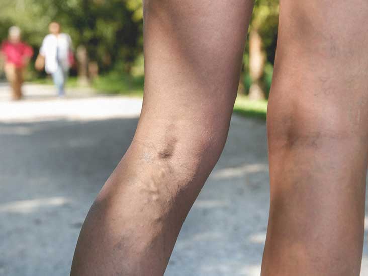 Advmedspa1's tweet photo. Did you know? The American Society for Vascular Surgery estimates that 40 million Americans have varicose veins! https://t.co/sP36qj08lE