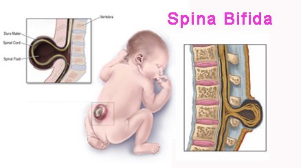 Spina bifida
#congenitaldisorders #spinaldeformities #neonatology
pediatricsresearchjournal.com