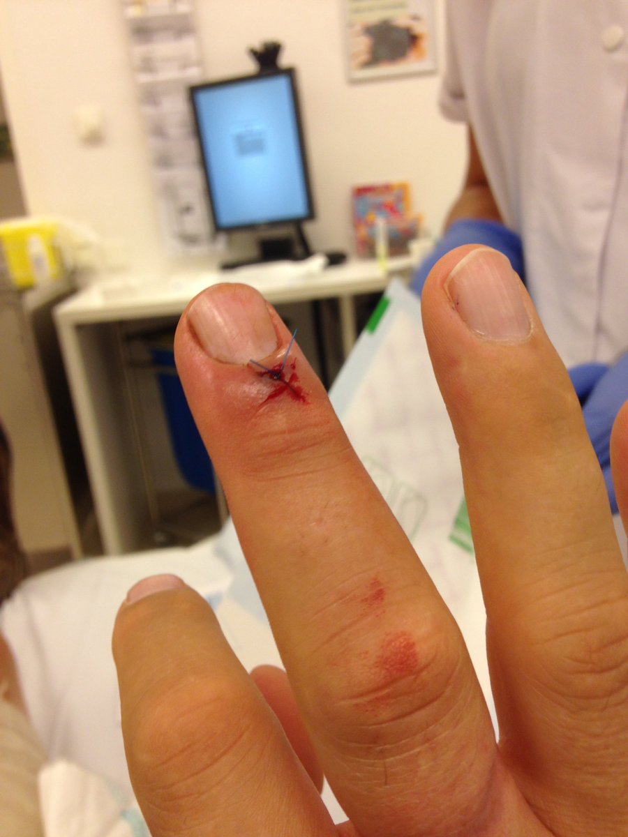 Altijd opletten met het schoonmaken van de speldenvanger...