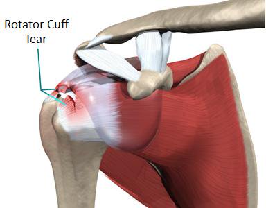 IMEProvider's tweet image. What causes rotator cuff injuries? Learn all the details in our latest article: bit.ly/2gnb38u