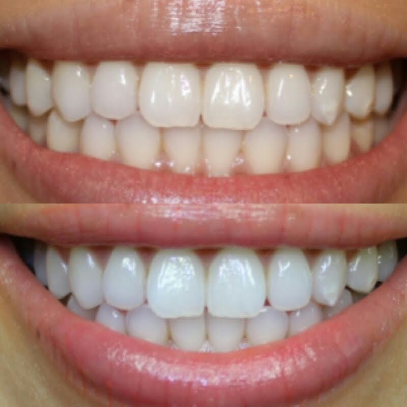 KDExcellence's tweet photo. Smile makeovers can be used to #transformyourappearance and give you the #Hollywoodsmile you have always wanted! https://t.co/rYcd9k99fK