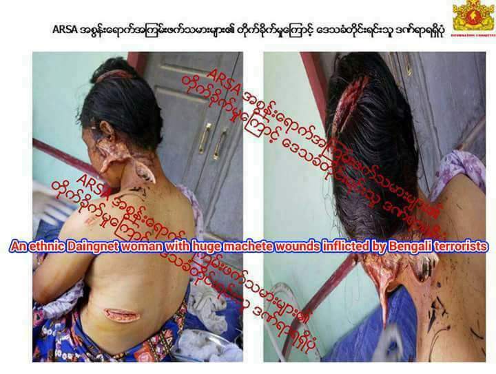 YeThuRein672139's tweet photo. #Rakhine news
An ethnic Daingnet woman with huge machete wounds inflicted by #Bengali #terrorists
#Maungdaw #Butma
@CNN @RFA https://t.co/ZTBkMIBlN9