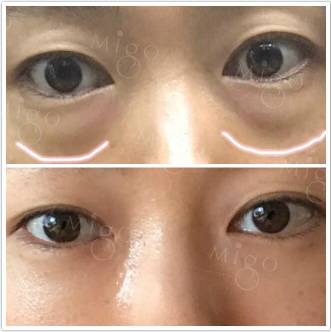 Migo_Clinic's tweet photo. Dark cycle is gone 1 week after surgery! #migoclinic #migoplasticsurgery #instabeauty #beforeandafter #medical #drkohanwoong #Darkcycle https://t.co/VfEP8pmic9