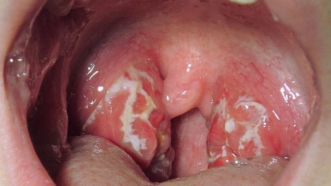 medicalprepper's tweet photo. Strep Throat | Diagnosis and Treatment https://t.co/qZTF5A5NkZ https://t.co/VUkC3CgqDe
