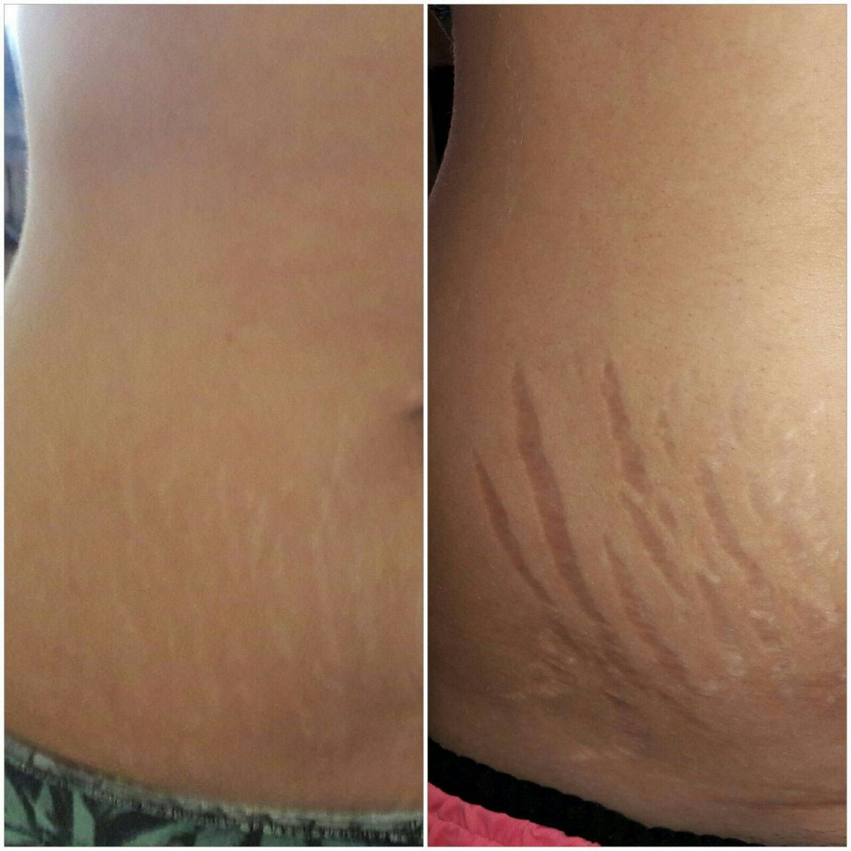weredefineyouth's tweet photo. Real Results. Real Women
#realresults #stretchmarksgone #YoungerNow #lookingfabulous #Jeunesse #WellnessPoint
Check Link in Bio! https://t.co/Z8ENeZ2657