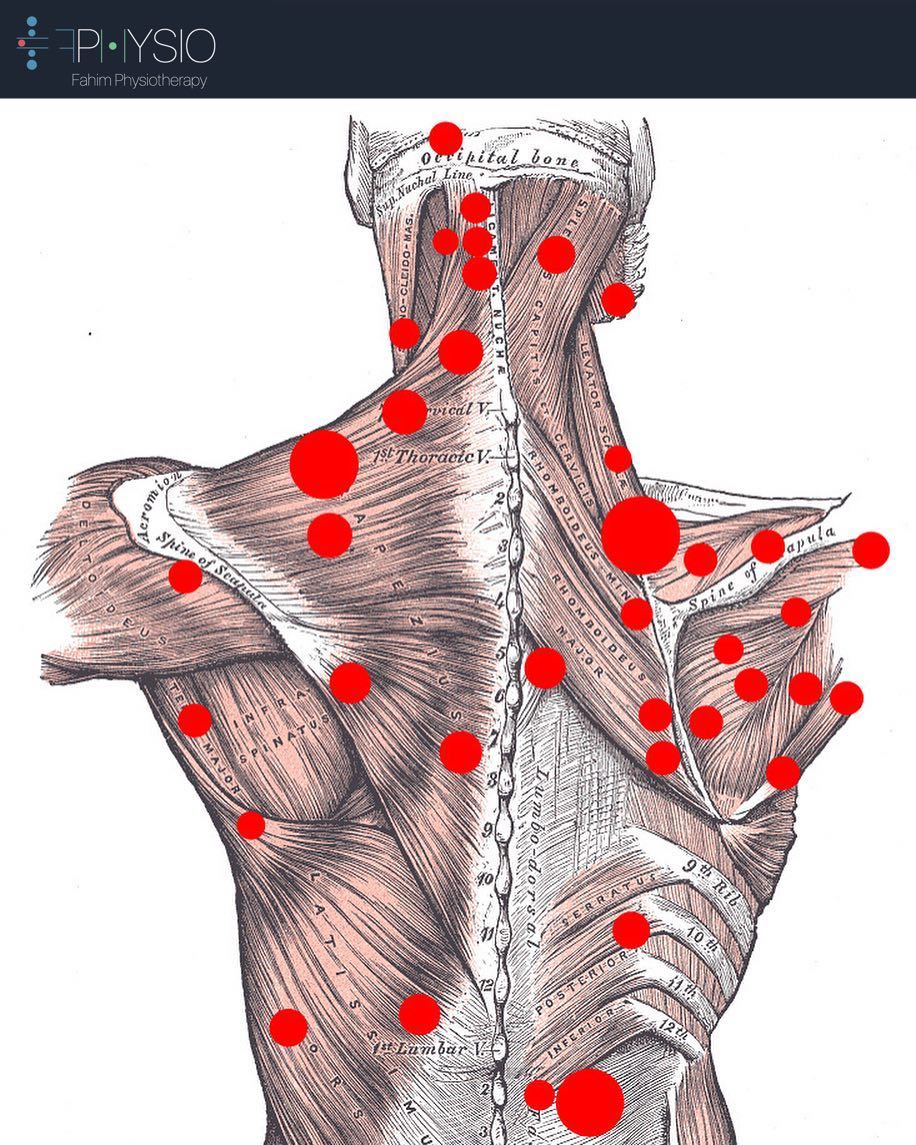 FPHYSIOTHERAPY's tweet photo. A few of the common sites of Trigger Points.
#physiotherapy #PhysicalTherapy #physiotherapist #triggerpoints https://t.co/AcfHyRp5CB