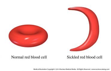 UGuerrier's tweet photo. September is Sickle Cell Awareness Month...
Sickle cell disease is one of the most common inherited genetic disorders in the country. https://t.co/2xxd4RIANc