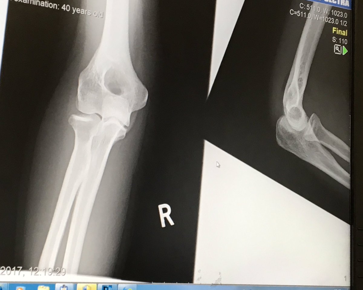 jennyagriffiths's tweet image. So I have a really wimpy barely there fracture in the region of the mouse arrow. #ArmUpdate