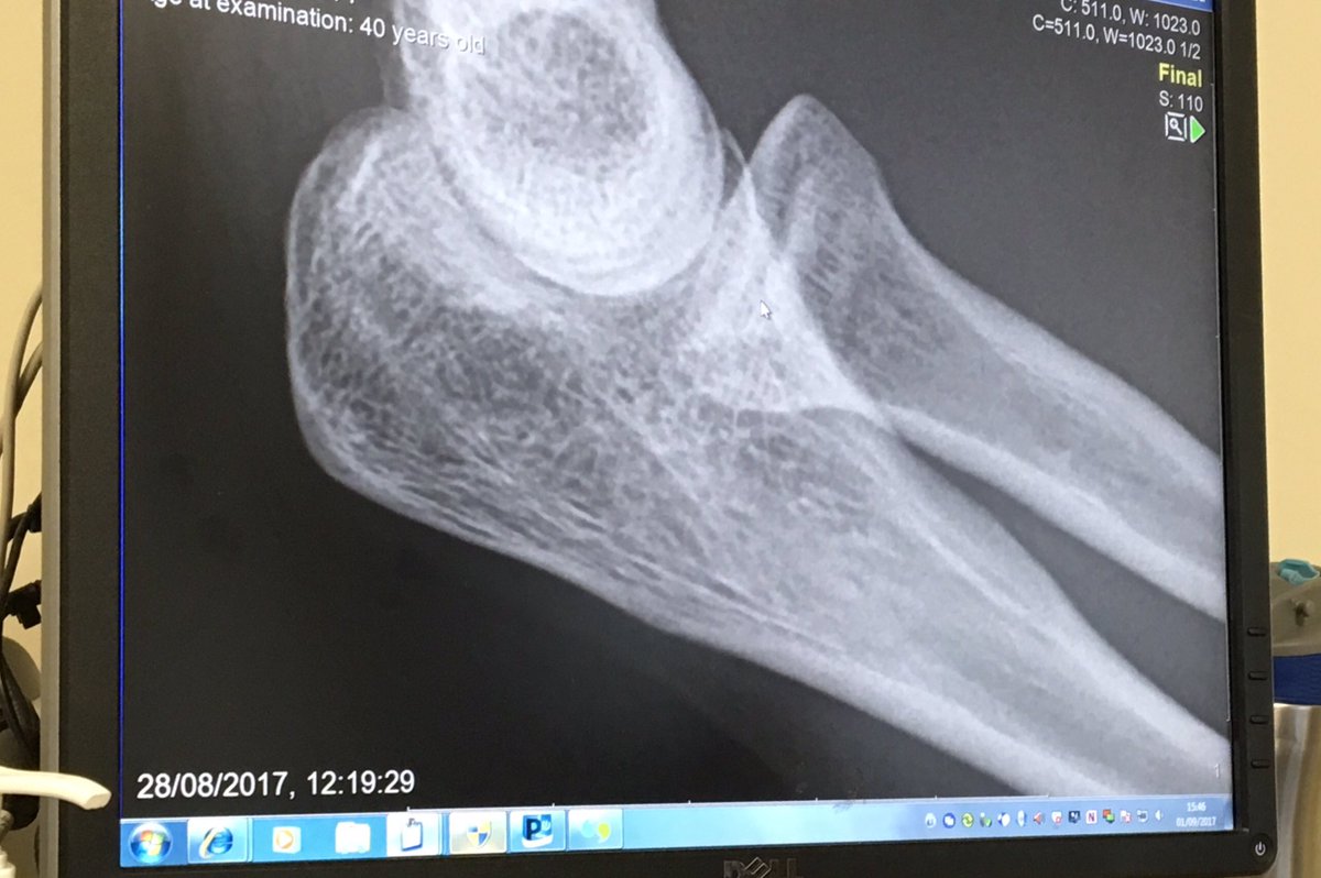 jennyagriffiths's tweet image. So I have a really wimpy barely there fracture in the region of the mouse arrow. #ArmUpdate