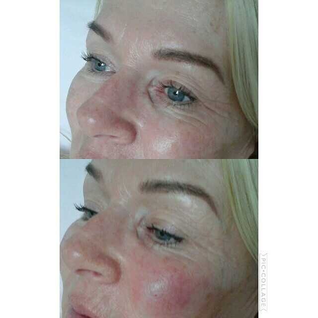 PatriotSister's tweet image. Tear trough treatment done in clinic using 1ml restylane refyne. #dermalfillers #advancedfillers