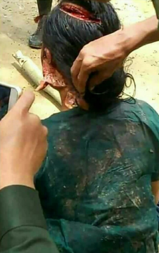 This young Rakhine girl was under brutal attack by Bangali  terrorists.
