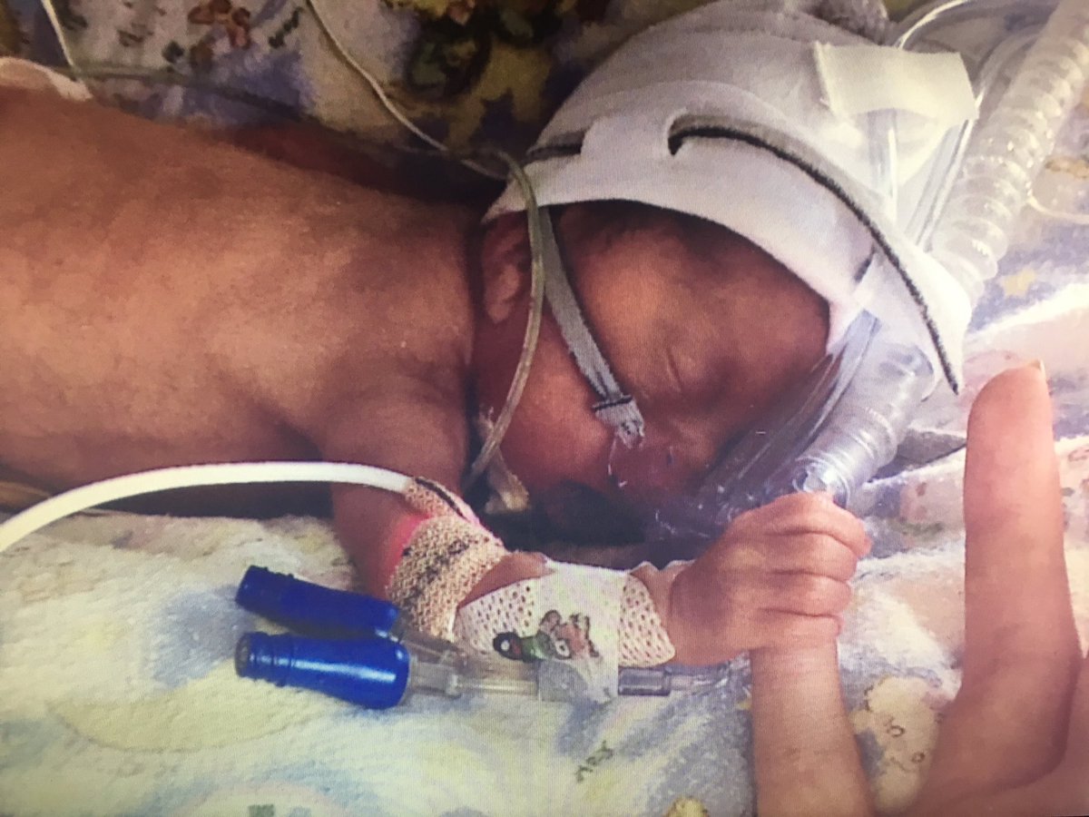 PaulByrne_1's tweet photo. Little Eva is one of 2k babies born prematurely here each year. See her story on #3News @5.30 @BurnShaveCUMH @HSELive @CUH_Cork @CUHCharity https://t.co/Y94wD0rjzw