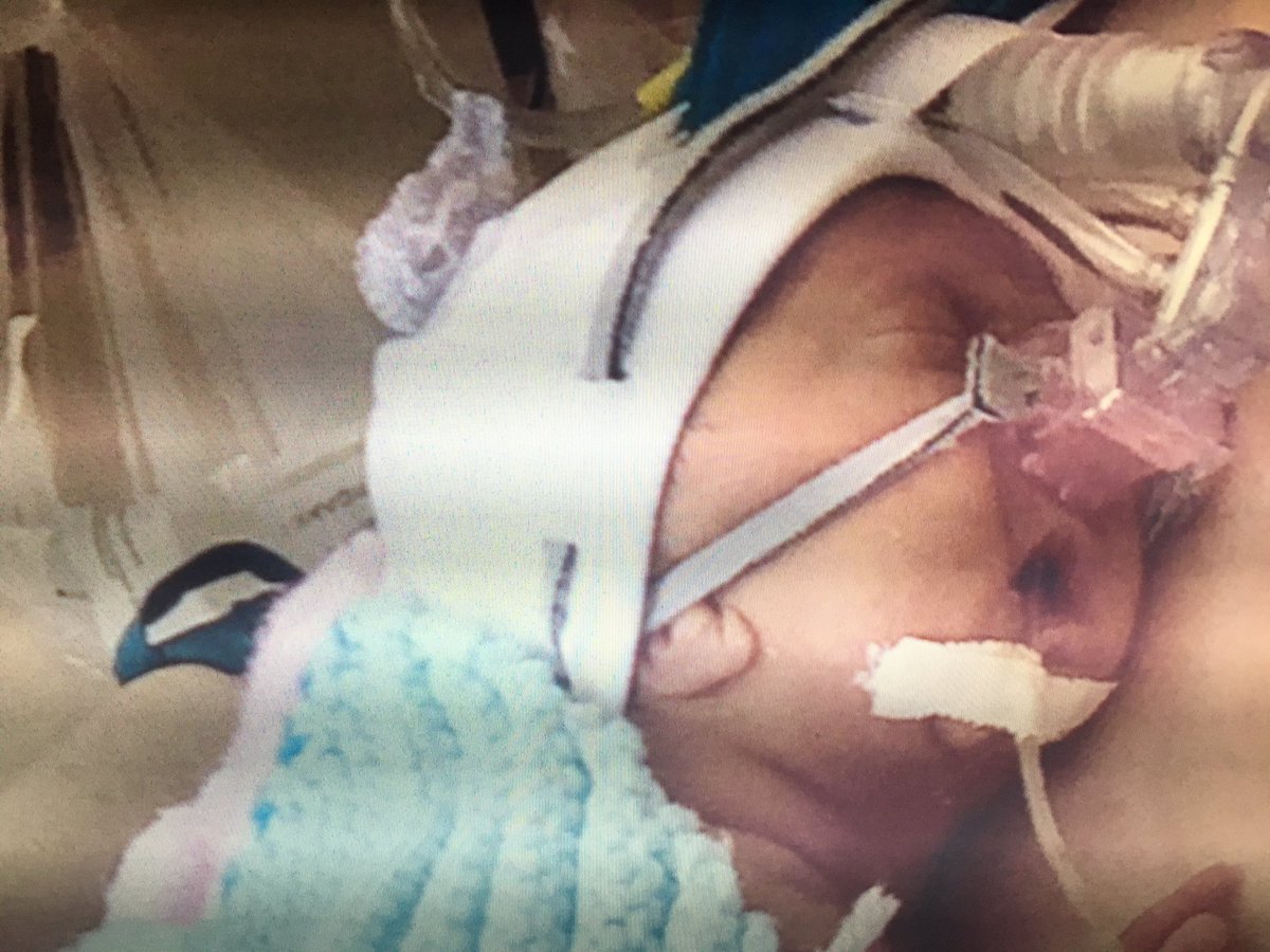 PaulByrne_1's tweet photo. Parents of Eva born prematurely want to give something back to medics who saved her. @BurnShaveCUMH @CUH_Cork @CUHCharity #3News @5.30 https://t.co/6d4NkfhPTJ