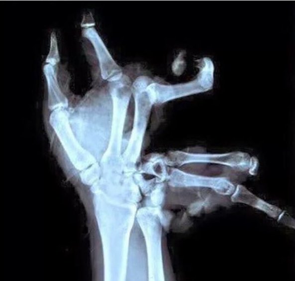 casparloves's tweet photo. a normal hand and lily's hand @MichaelFinchxo https://t.co/CBlWCxYC4c