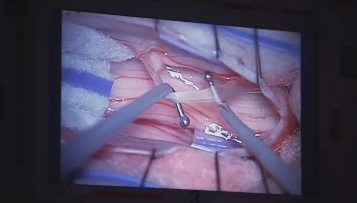 DrCruzeiro's tweet photo. A rizotomia dorsal seletiva é uma técnica cirúrgica utilizada no tratamento da #espasticidade, sintoma comum em várias doenças neurológicas. https://t.co/kBsk12RsHS