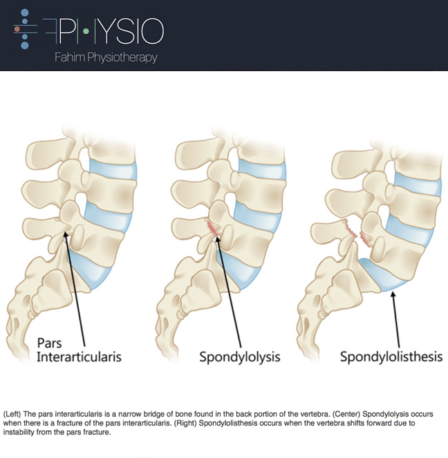 FPHYSIOTHERAPY's tweet photo. #ParsInterarticularis #Spondylolysis #Spondylolisthesis https://t.co/hXC6BR08hc