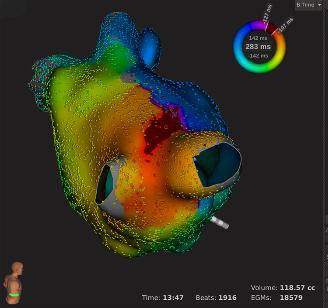 RevEspCardiol's tweet photo. Ablación de FA guiada por un nuevo sistema de navegación no fluoroscópica https://t.co/IjlwlnOWrU https://t.co/wG5CIBi6yS