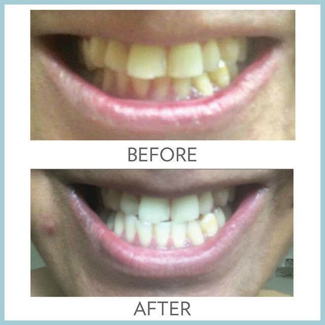 rula_berg's tweet photo. Wow! I just cant get over the result from this toothpaste!😁20 bucks to change your smile I have magic toothpaste on hand! I will hook you up https://t.co/ubUpoYMewm