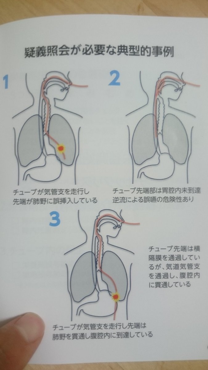 吉沢 Sur Twitter 3番ってありえる 挿入してて 気管内入ったなってのはすぐ分かるし どこかで引っ掛かってる とぐろ巻いてるなっての は指先の感覚で気がつくと思うな マーゲンチューブ Ngチューブ Ndチューブ 施設や病院によって呼び方違いますねぇ T 吉沢 Sur Twitter 3番ってありえる 挿入してて 気管内入ったなってのはすぐ分かるし どこかで引っ掛かってる とぐろ巻いてるなっての は指先の感覚で気がつくと思うな マーゲンチューブ Ngチューブ Ndチューブ 施設や病院によって呼び方違いますねぇ T