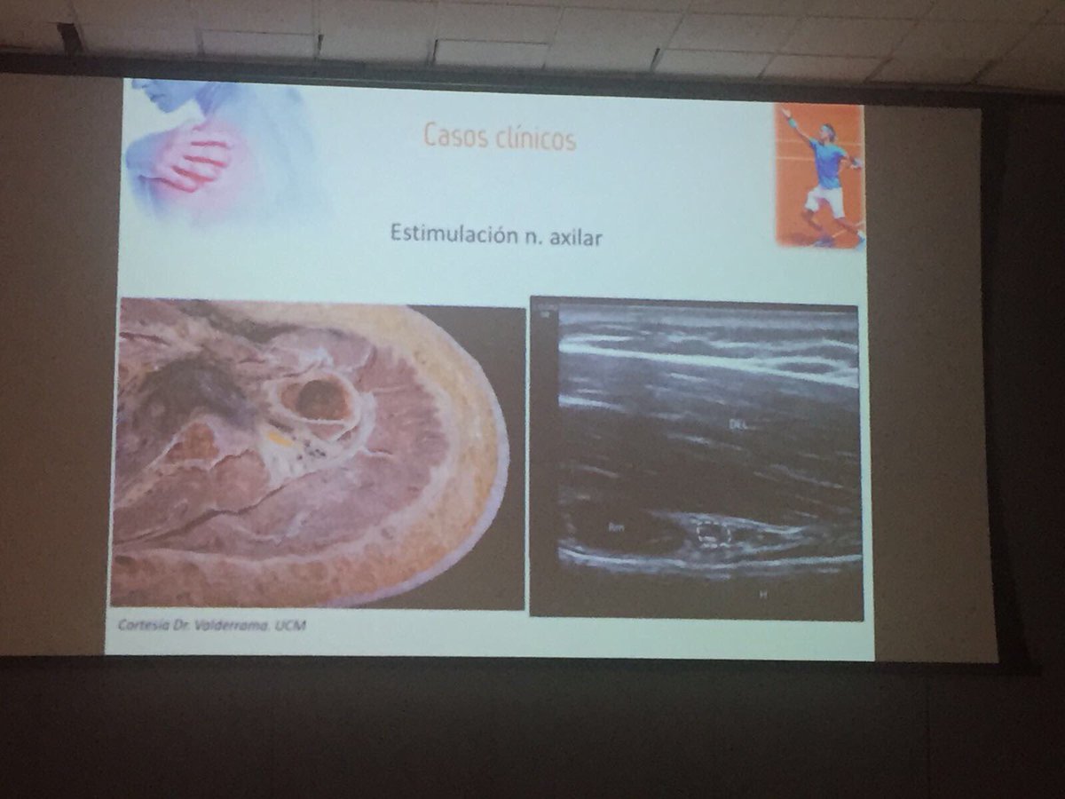 MVClinic's tweet photo. #FranMinaya habló sobre Mesoterapia en el aparato locomotor, y Neuromodulacion percutánea ecoguiada en el dolor crónico @NeuroMPercut https://t.co/GjRtVNWbCp