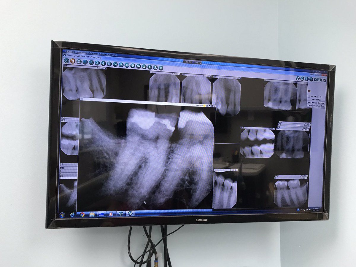 _K_O's tweet photo. Waiting for my dentist to 3D print my new crown after I cracked the first one. #IEatNailsForBreakfast https://t.co/roujLJPlKu