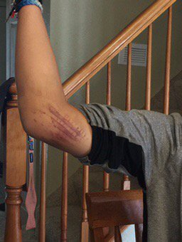AIAPHYSIO's tweet photo. Check out how Rock Tape gets rid of bruising.  Contact us to help with bumps and bruises! https://t.co/3sPd1Z2kuf