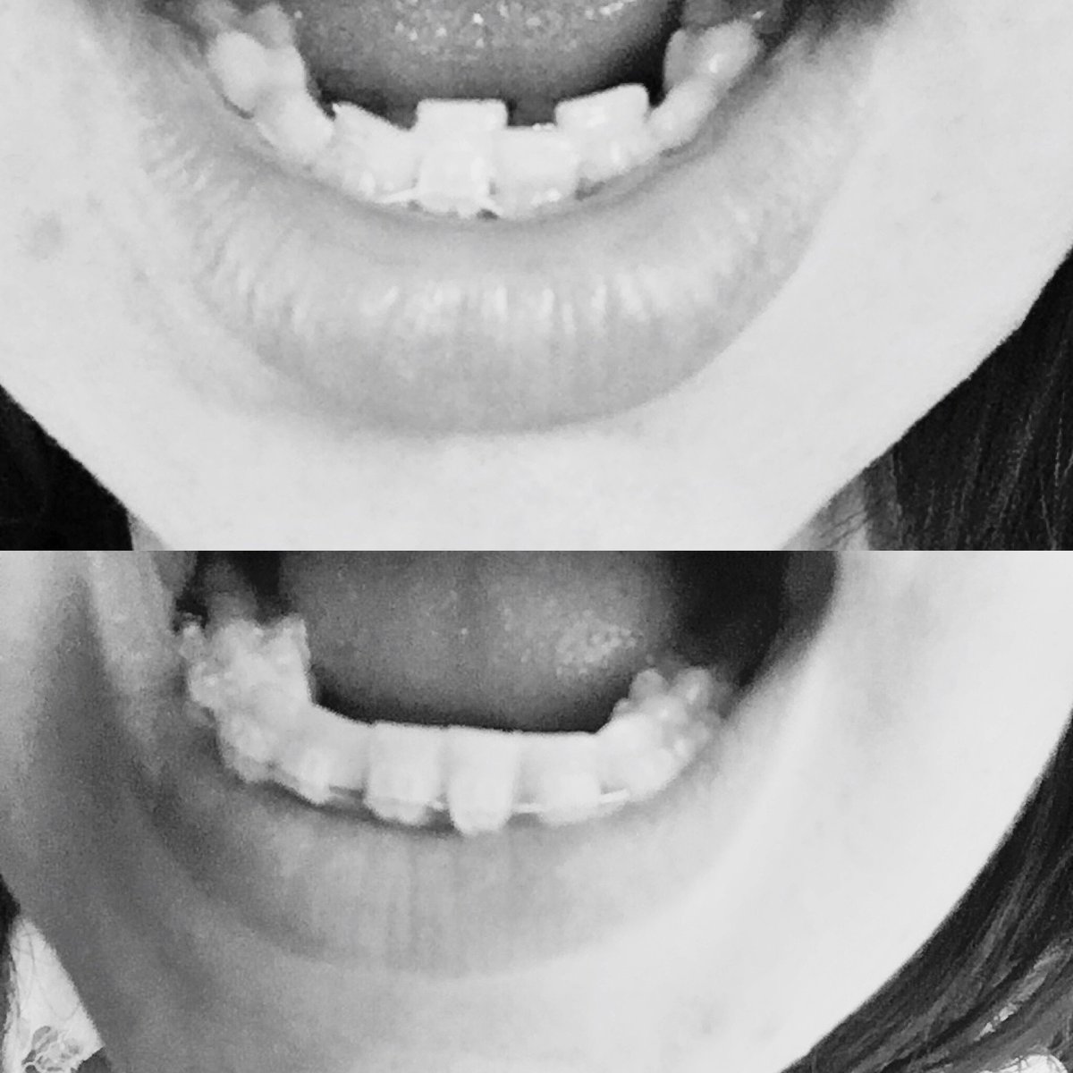 RhiFisherPR's tweet photo. check out the results after 2 months of braces 😁 #6monthsmile #quickstraightteeth https://t.co/E7ZnFRLoIt