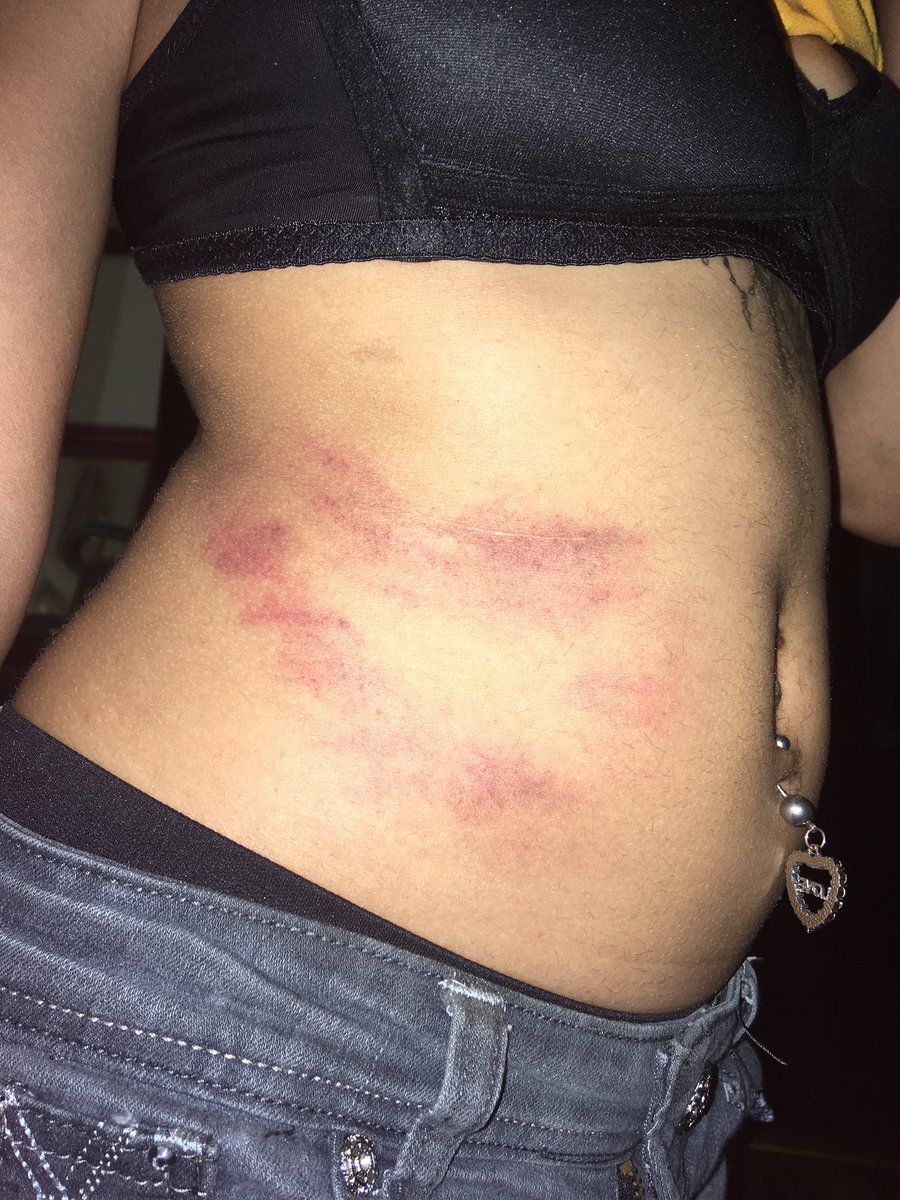 _ClassyStylist's tweet image. Did the heart ❤️hickie challenge with my bf