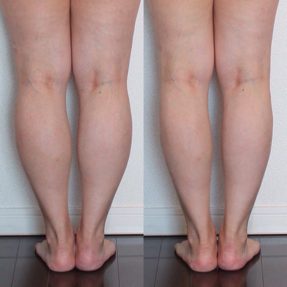 Vimuse Sword Vimuse のビフォーアフター ふくらはぎにパイラソードを１回あてた結果 スッキリ Pyrsword パラボラ痩身法 ダイエット 部分痩せ 脚痩せ パイラソード Vimuse Thankyouvimuse T Co Umeve6bbxk