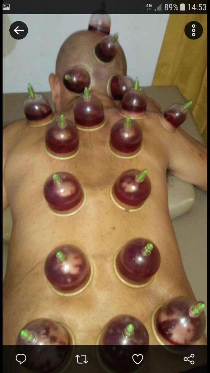 Bekam Mencegah stroke