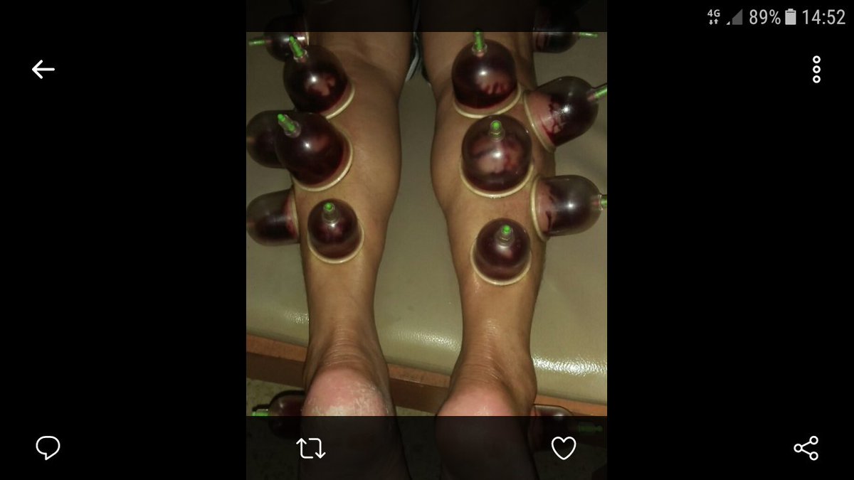 Bekam Dahsyat kram asam urat Sembuh Insyaa Allah