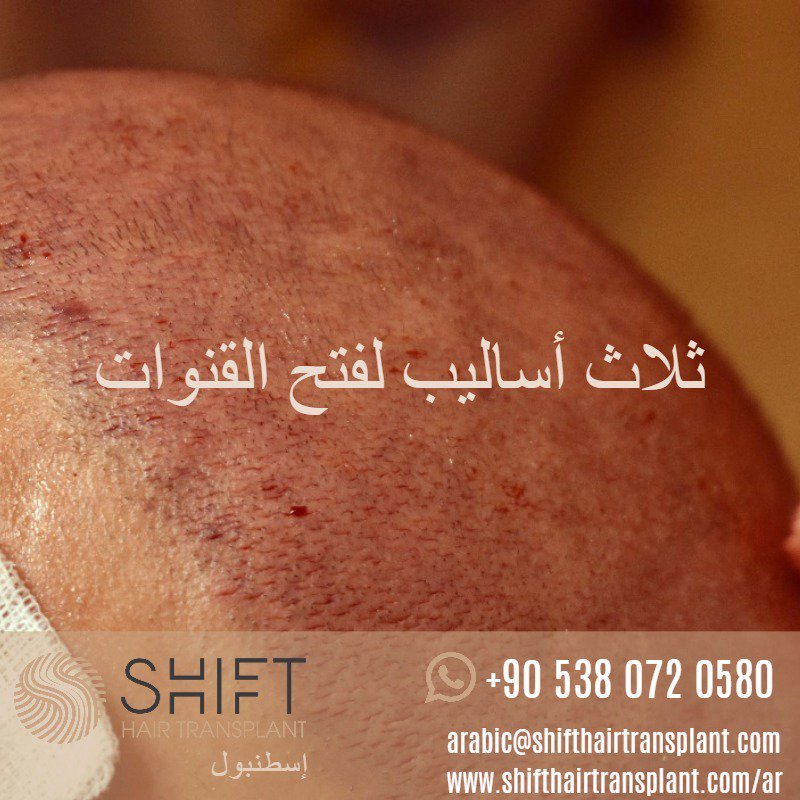 shifthair_ar's tweet photo. #زراعة_الشعر #زراعة_اللحية #زراعة_الشعر_للنساء #زراعة_الحواجب #زراعة_الذقن #تقنية_بيركوتان #تقنية_ألترا_سليت #تقنية_osl #زراعةالشعر #تركيا https://t.co/fuOaArDGmn