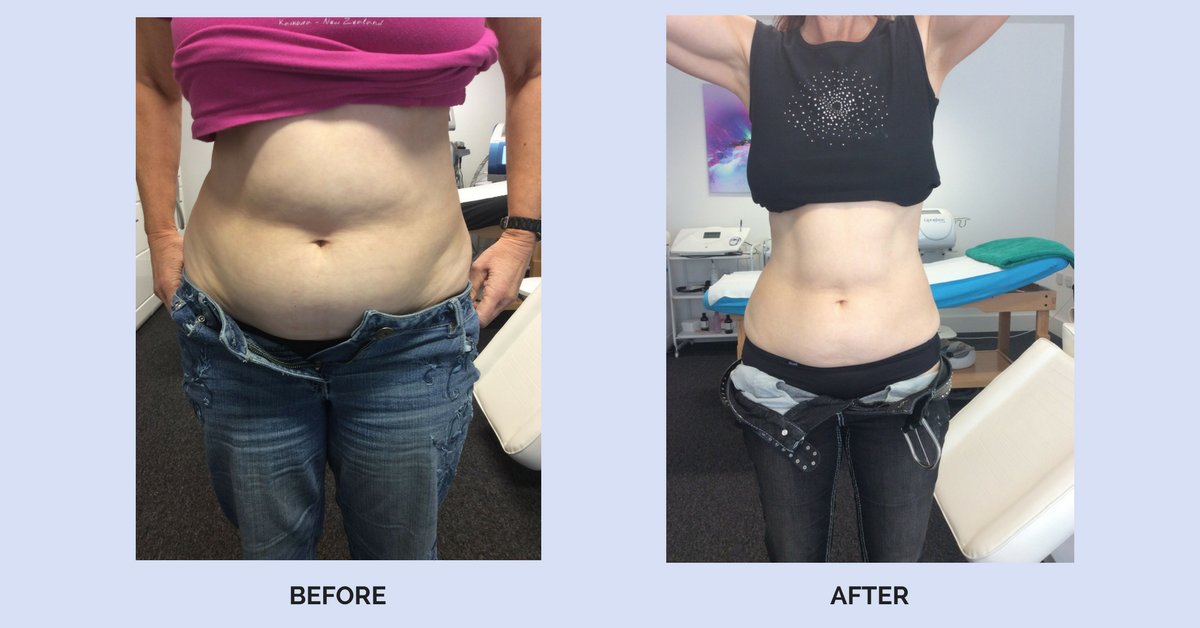 #Lipoglaze for a non-invasive way to permanently remove and reduce fat from the body see results and learn more clinic33.co.uk/fat-loss-treat…